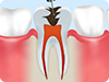 重度の虫歯治療～根管治療～