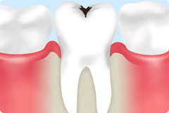 乳歯の虫歯はどうすればいいの？