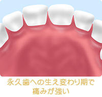 永久歯への生え変わり期で痛みが強い