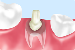白い歯を入れる前に……「土台」が重要です